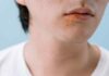 Comment traiter un bouton de fièvre naturellement et rapidement ? Comment traiter un bouton de fièvre naturellement et rapidement ? Marie Lopez