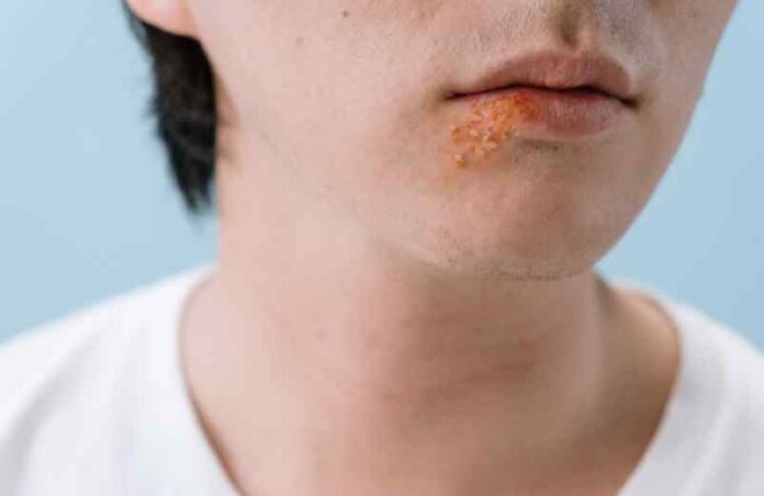 Comment traiter un bouton de fièvre naturellement et rapidement ? Marie Lopez Comment traiter un bouton de fièvre naturellement et rapidement ? Marie Lopez