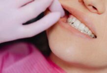 Enlever le tartre des dents avec des astuces de grand-mère Enlever le tartre des dents avec des astuces de grand-mère Marie Lopez